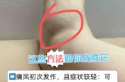痛风能治好吗_痛风会遗传吗