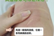 风湿性关节炎能治好吗_风湿病早期症状有哪些
