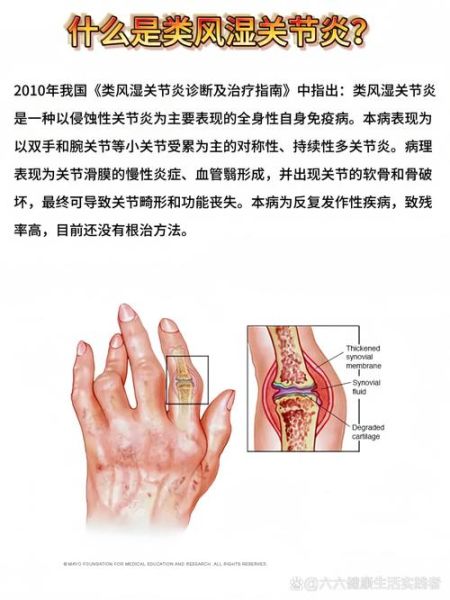 风湿性关节炎能治好吗_风湿病早期症状有哪些